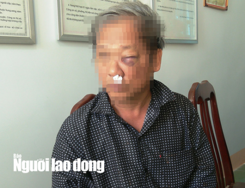 Nhà báo Hoàng Đình Chiểu bị đánh thâm tím vùng mặt