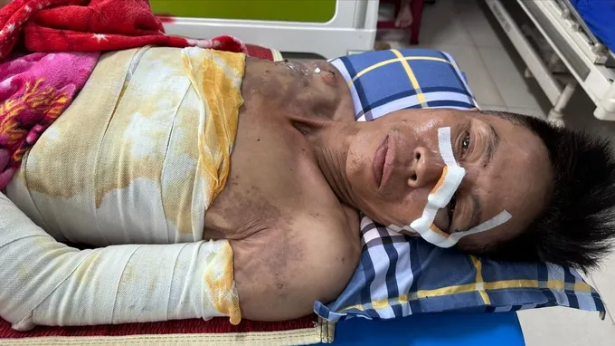 Người đàn ông nghèo bị bỏng nặng, không tiền điều trị
