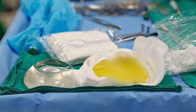 Vỡ túi ngực cả năm mà không hay biết, bác sĩ cảnh báo biến chứng âm thầm