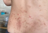 Hàng trăm người ở Hà Tĩnh bị bọ chét đốt gây sẩn ngứa khắp người