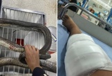 Bị rắn hổ mang cắn, người phụ nữ 47 tuổi tay không hạ gục con rắn rồi mang đến bệnh viện