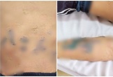 Tự đắp lá chữa bệnh sởi, nam thanh niên 17 tuổi nhập viện gấp