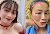 Gương mặt sưng vù của hot girl bóng đá sau va chạm