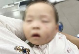 Tạm giữ nữ giáo viên trong vụ bé gái có nhiều vết bầm tím chi chít trên mặt
