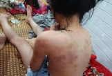 Nữ sinh lớp 4 bị nhóm bạn hành hung, cơ thể nhiều vết thâm tím