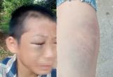 Xôn xao clip bé trai mắt bầm tím, khóc kêu cứu vì nhiều lần bị đánh đập khi ở cùng bố và vợ mới