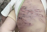 Bé trai 2 tuổi nghi bị mẹ và người tình bạo hành gây hôn mê, đa chấn thương