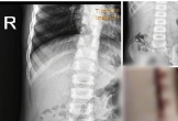 Xôn xao việc bác sĩ ph.ẫu th.uật lấy d.ị v.ật cho một b.ệ.nh nhi ở Nghệ An